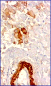 El inmunomarcaje con Actina muscular especfica se observa en la pared de los vasos y en la membrana y citoplasma de algunas clulas neoplsicas